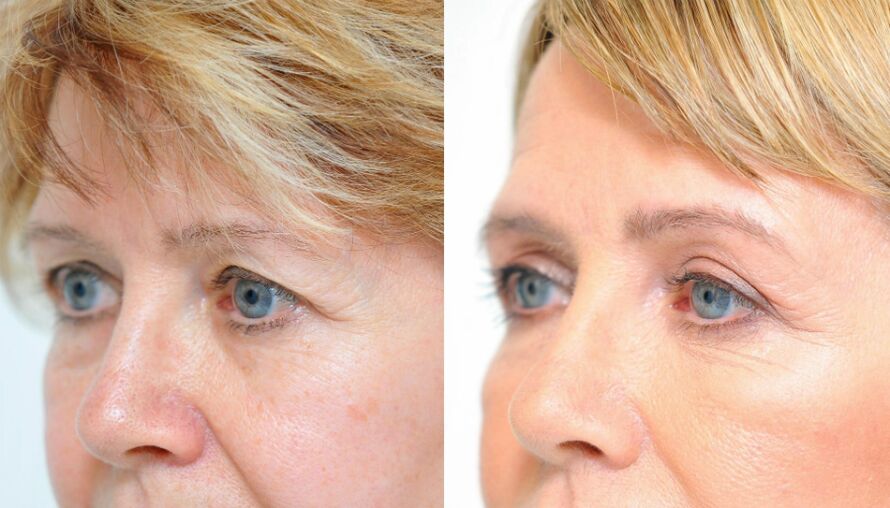 blefaroplastika-prej-in-potem